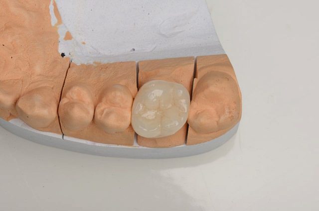 Коронки из диоксида циркония